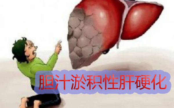 郑州那个肝病医院治疗肝硬化比较好